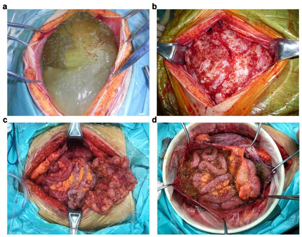 Виды псевдомиксомы брюшины [33]
