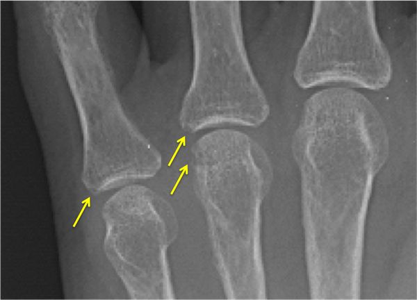 Эрозии суставных поверхностей костей [24]
