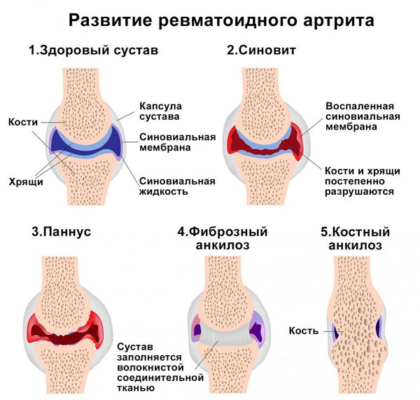 mehanizm razvitiya revmatoidnogo artrita s