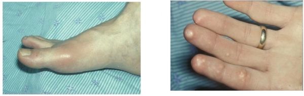 Отёк и покраснение суставов [23]