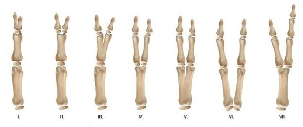Классификация радиальной полидактилии по Wassel