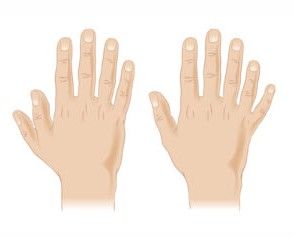 Полидактилия