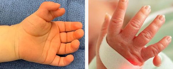 Радиальная и ульнарная полидактилия [1][11]