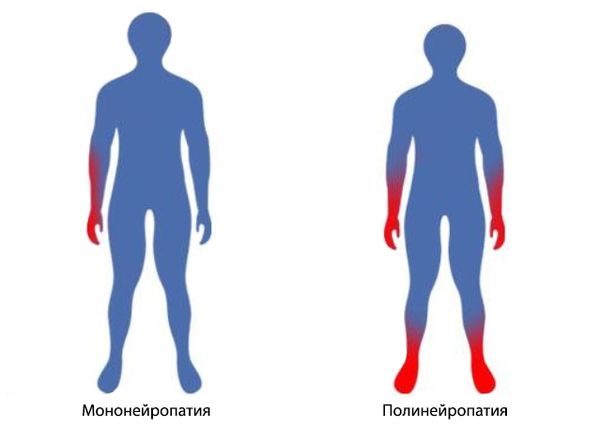 Мононейропатия и полинейропатия