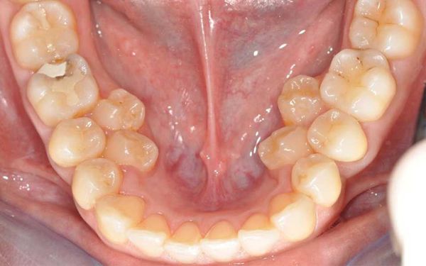 Сверхкомплектные зубы