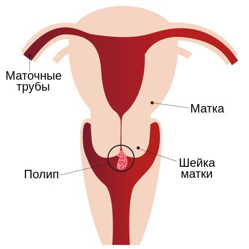 Полип эндометрия – симптомы, причины, признаки, диагностика и лечение в «СМ-Клиника»