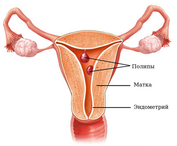Полипоз эндометрия матки конкременты в желчном пузыре