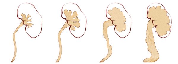 Стадии гидронефроза