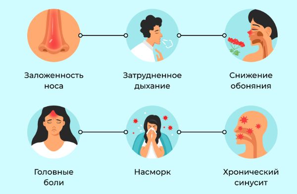 Основные симптомы полипоза носа Основные симптомы полипоза носа