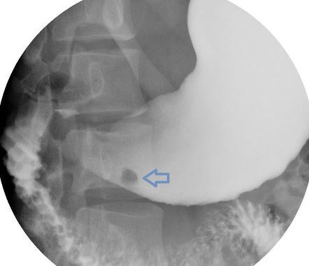 Полип желудка на рентгеновском снимке
