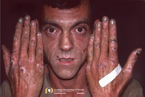Человек с поздней кожной порфирией [12]