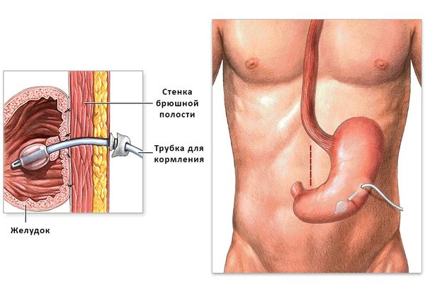 Гастростома Гастростома
