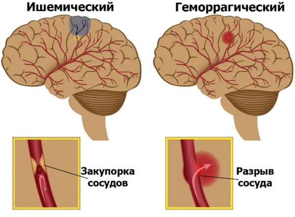 Ишемический и геморрагический инсульт Ишемический и геморрагический инсульт