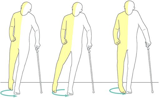 Пример походки при инсульте: чтобы сделать шаг поражённой ногой, пациент совершает ею круговое движение [21]