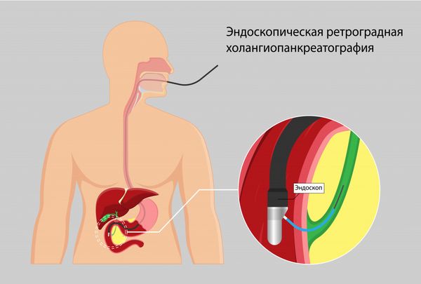 Холангиопанкреатография