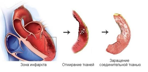 Постинфарктный кардиосклероз