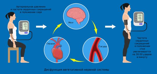 Ортостатическая непереносимость