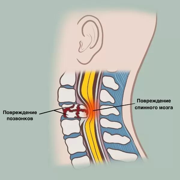Повреждение спинного мозга при травме позвоночника