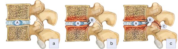 Снижение высоты межпозвоночных дисков и  увеличение нагрузки на дугоотростчатые суставы [16]