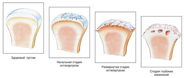 Стадии остеоартроза