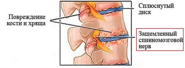 Защемление спинномозгового нерва при спондилоартрозе