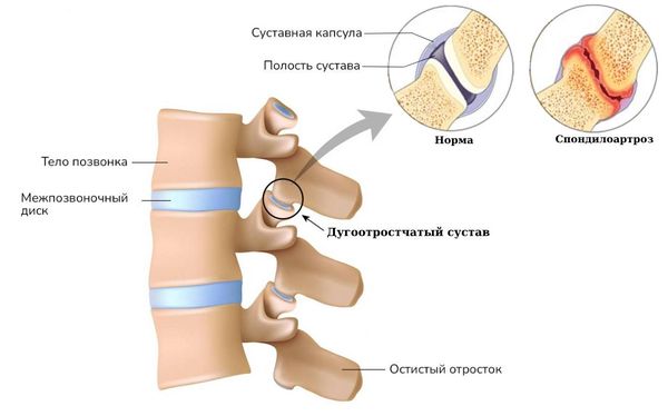 Лечение спондилоартроза пояснично крестцового отдела позвоночника