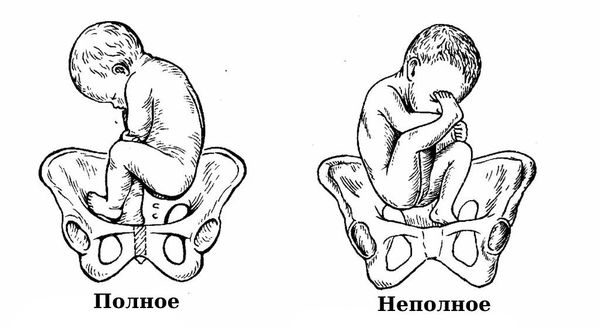 Ножное предлежание