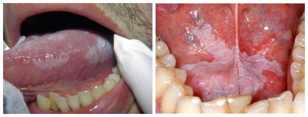 Белый налёт в полости рта при лейкоплакии [20, 21]