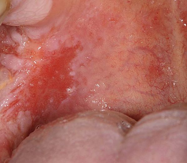 Красное пятно в полости рта при эритроплакии [22]