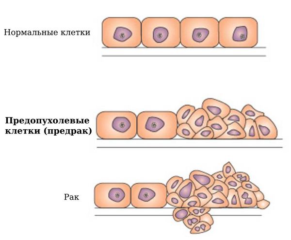 Нормальные, предопухолевые и раковые клетки