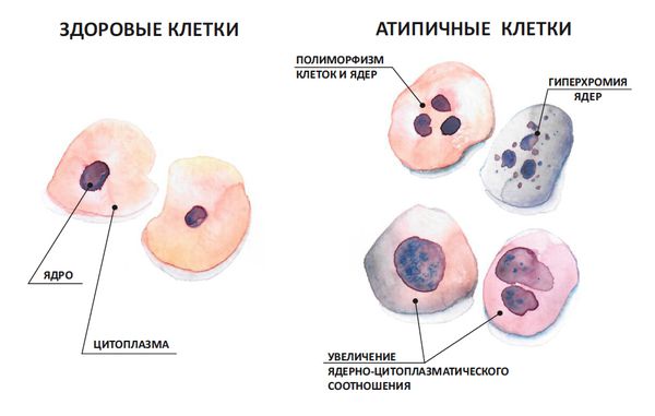 Здоровые и атипичные клетки