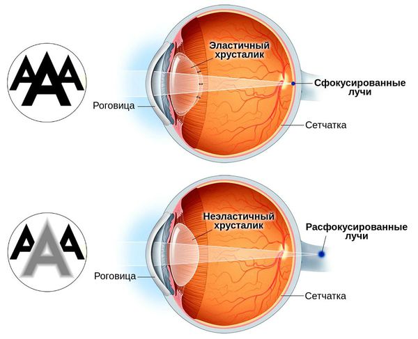 Пресбиопия глаз что это такое у взрослых лечение