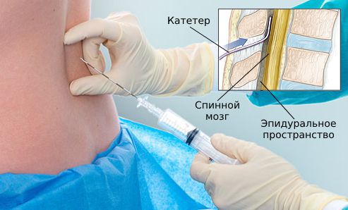 epiduralnaya anesteziya s