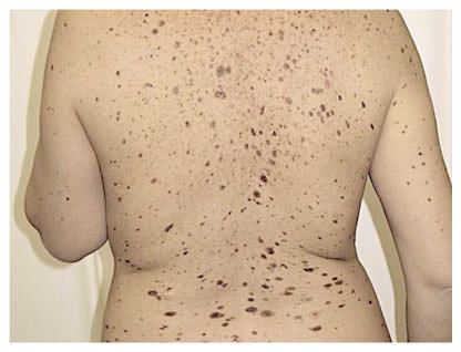 Множественные поверхностные невусы [58]