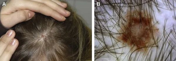 Невус по типу «затмения» [59]