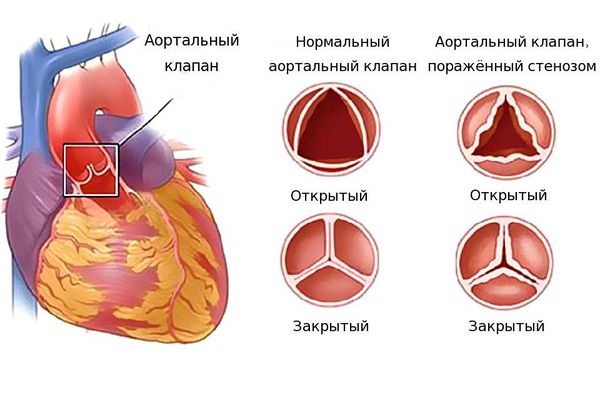 Аортальный клапан в норме и при стенозе