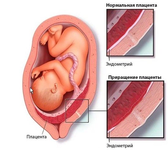 Плацента по передней стенке