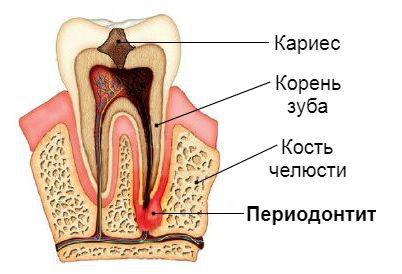 кариес сбоку зуба можно ли вылечить. Смотреть фото кариес сбоку зуба можно ли вылечить. Смотреть картинку кариес сбоку зуба можно ли вылечить. Картинка про кариес сбоку зуба можно ли вылечить. Фото кариес сбоку зуба можно ли вылечить