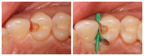 Препарирование и пломбирование зуба