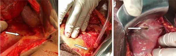 Прободная язва желудка на передней стенке пилорического отдела у трёх разных пациентов [16]