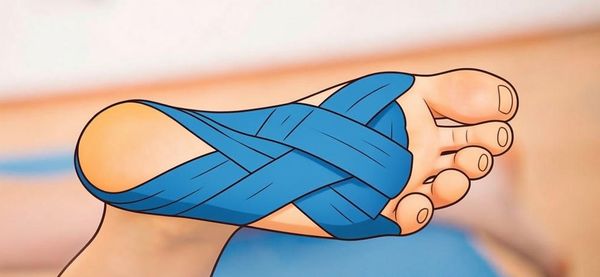 Кинезиотейпирование стопы