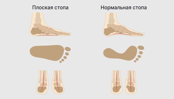 Продольное плоскостопие
