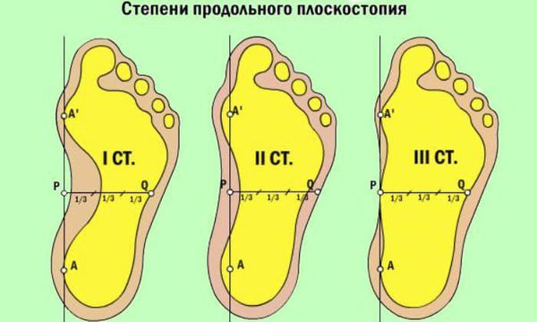 Степени плоскостопия