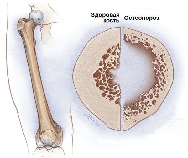 Снижение плотности костей Снижение плотности костей