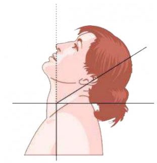 Ретроколлис