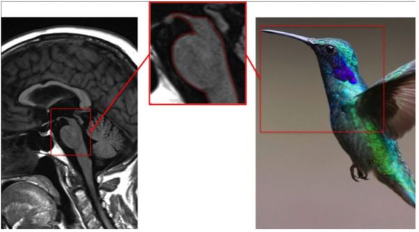 Симптом колибри [11]