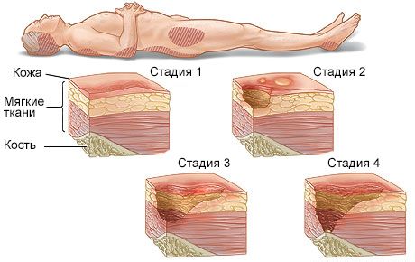 Стадии развития пролежней