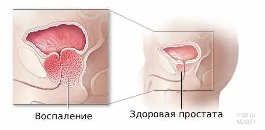 Простатит (воспаление простаты)