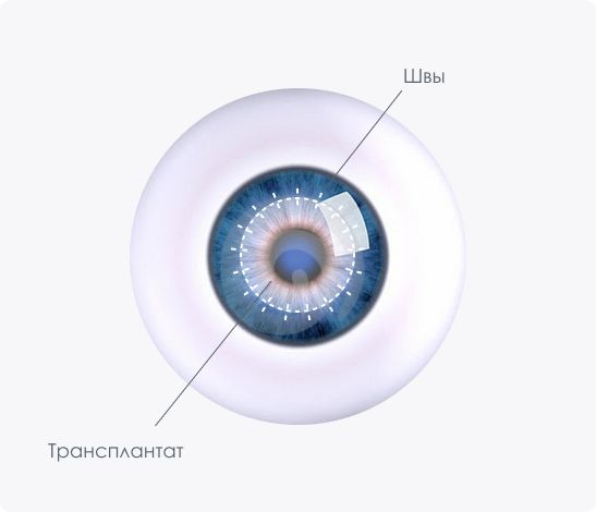 Кератопластика Кератопластика