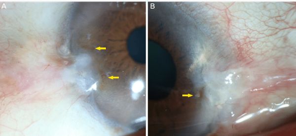 Линии Стокера [17]